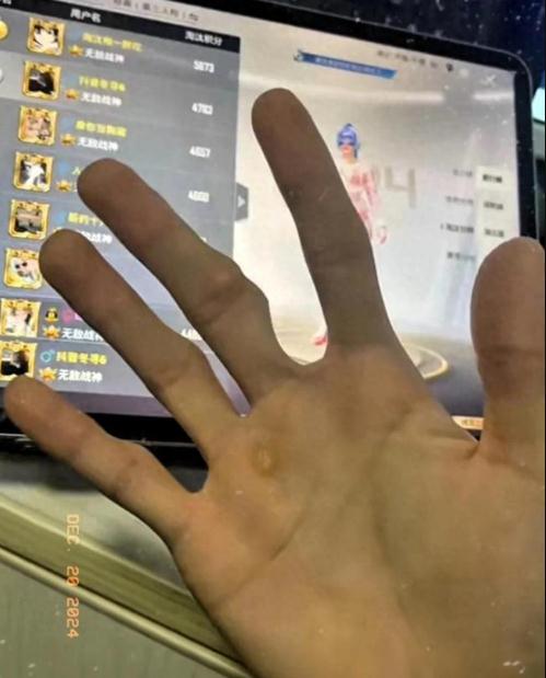 男子做游戏主播7年手指严重变形