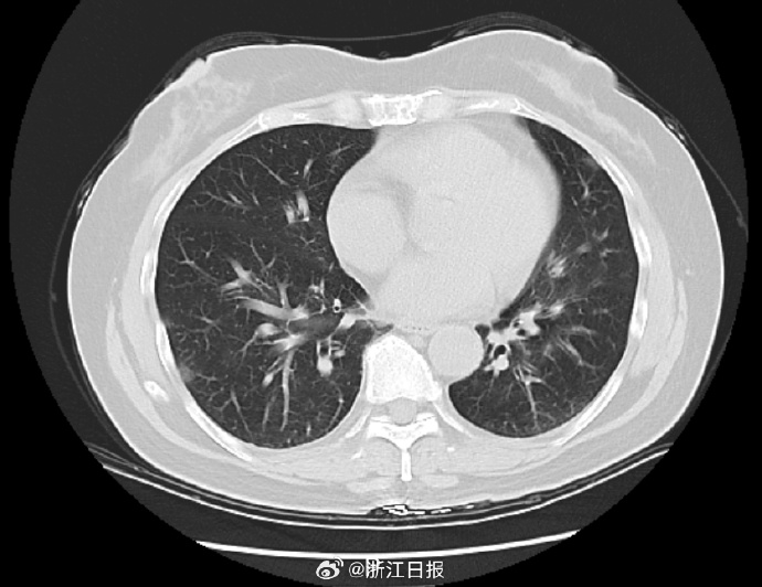 一家6口出游5人感染甲流