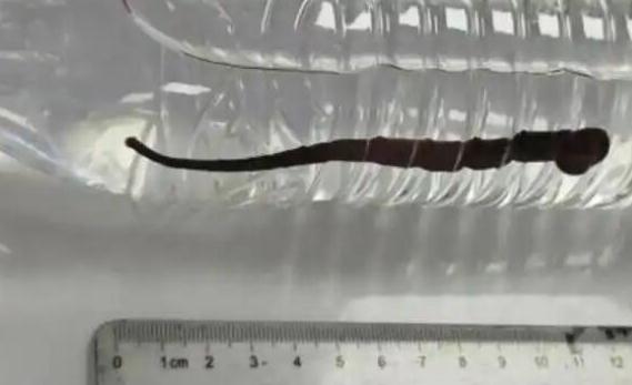 7岁孩子做雾化后咳出一条活体蚂蝗