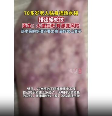 70多岁老人贴身捂热水袋捂出蟒蛇纹