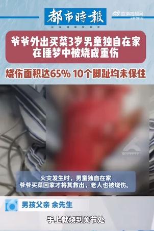3岁男童独自在家睡梦中被烧成重伤