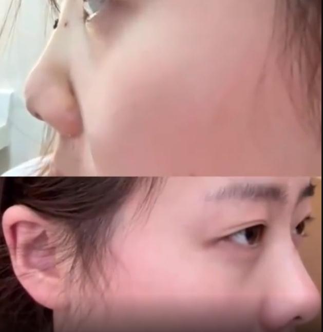 女子鼻骨骨折消肿后喜提高鼻梁 