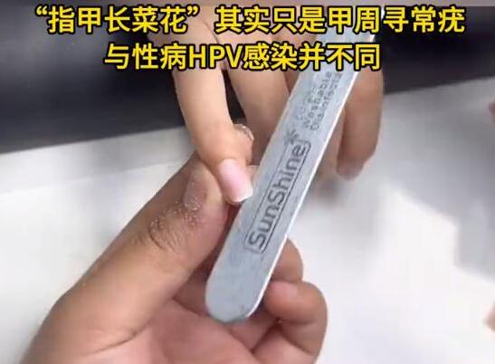 女子美甲后感染HPV病毒长出菜花