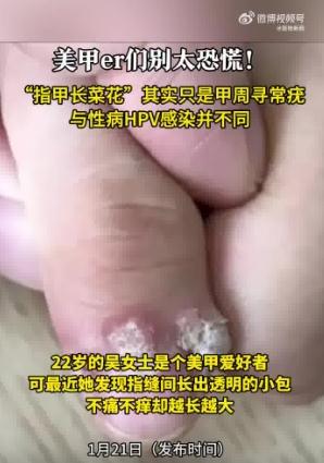 女子美甲后感染HPV病毒长出菜花