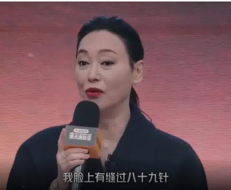 惠英红脸上缝了89针