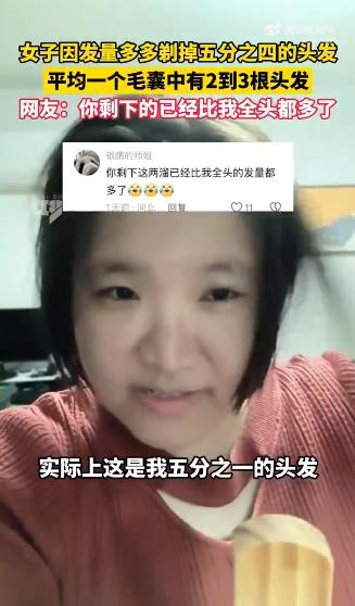 女子因发量太多剃掉五分之四头发